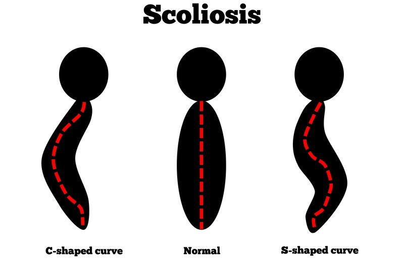 Chicago, IL scoliosis treatment